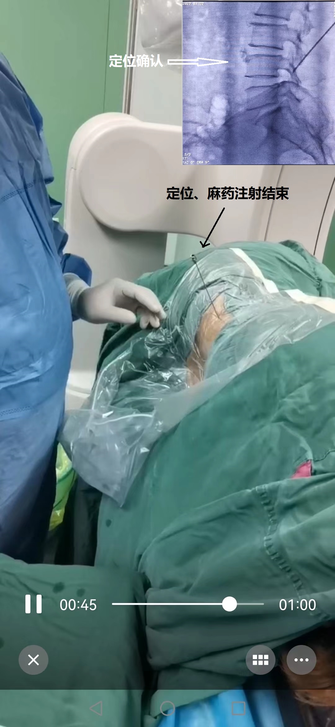 3-定位-麻藥注射結束.jpg