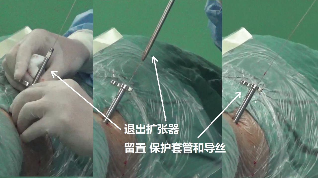 8-退出擴張器-留置保護套管和導絲.jpg