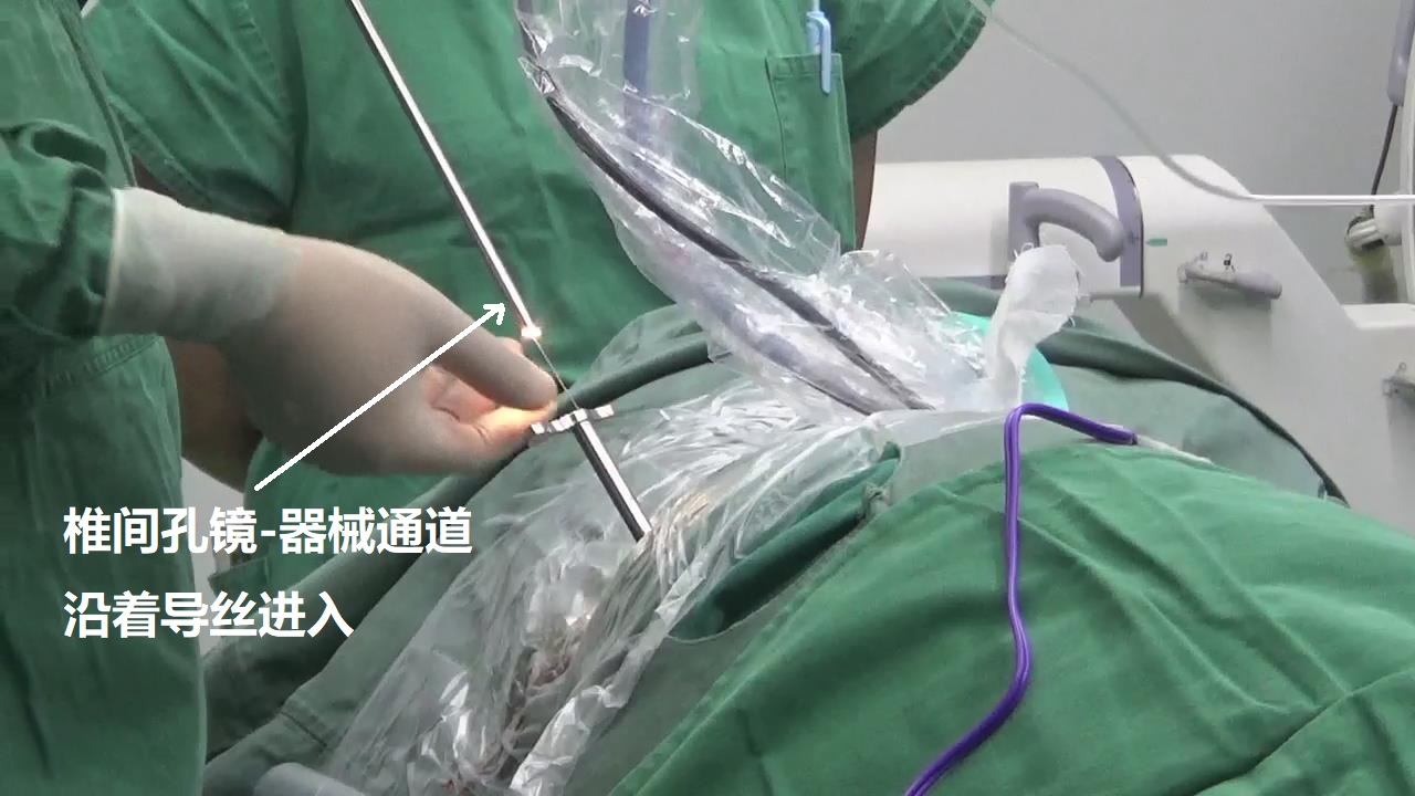 9-椎間孔鏡-進入.jpg