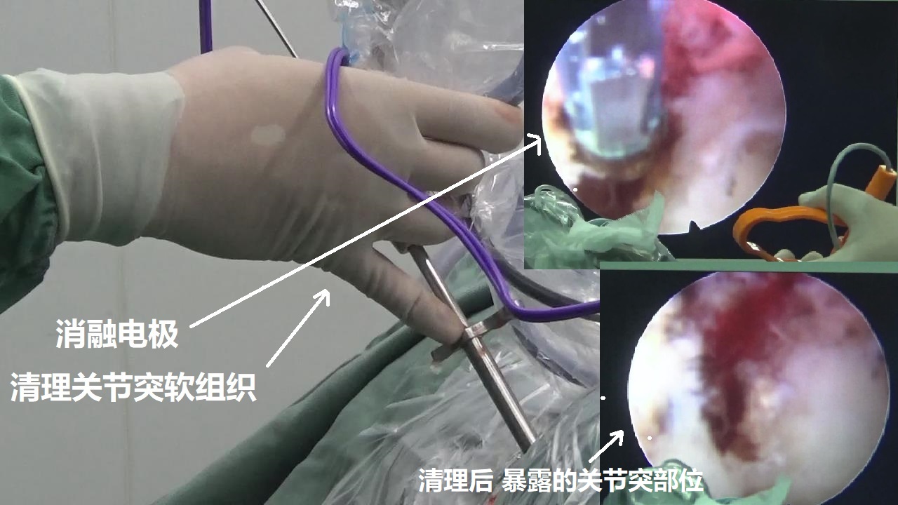 10-消融電極-清理關節突軟組織.jpg