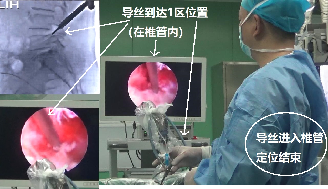 13-導絲到達椎管-定位結束.jpg